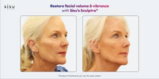 Sculptra for Sagging Skin & Volume Loss