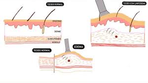 SciELO Brasil - Ultrassonografia como instrumento de avaliação do linfedema  secundário ao câncer de mama: revisão sistemática Ultrassonografia como  instrumento de avaliação do linfedema secundário ao câncer de mama: revisão  sistemática