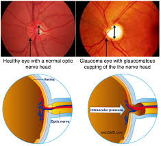 Oct 13, 2020 · glaucoma. Glaucoma High Internal Eye Pressure That Causes Vision Loss