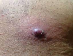 A pubic hair may, sometimes, get coiled as it grows, to enter back into the skin. Ingrown Pubic Hair Cyst Causes Treatment Tips