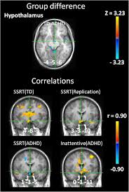 What are symptoms of attention deficit hyperactivity disorder (adhd), inattentive type, in adults? Bold Differences Normally Attributed To Inhibitory Control Predict Symptoms Not Task Directed Inhibitory Control In Adhd Journal Of Neurodevelopmental Disorders Full Text