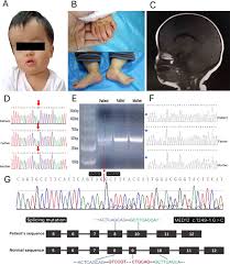 Frontiers Med12 Related Disease In A Chinese Girl Clinical Characteristics And Underlying Mechanism Genetics
