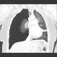 Image result for Pneumothorax