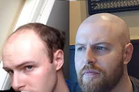 View our before & after thinning hair gallery. Scalp Micropigmentation Houston Tx Scalpp Houston Texas Smp