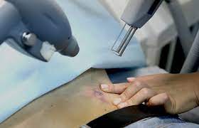 Most people will during treatment pain like rubber band snapping. Tattoo Removal Laser Price Specifications