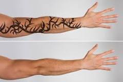Laser Tattoo Removal: How Long Does it Take to See Results? | FSL