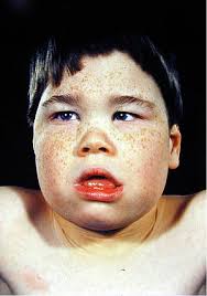Skin tags in front of eyes; Alpha Thalassemia Mental Retardation Syndrome Wikipedia