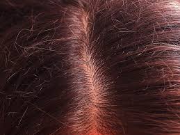 Le coup de soleil (ou érythème solaire) : Une Brulure Peut Elle Provoquer Une Alopecie