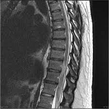Krankheitsschübe wie auch läsionen in der magnetresonanztomographie (mrt) reflektieren den krankheitsprozess bei der… teriflunomid reduziert den jährlichen verlust an hirnvolumen frankfurt, 02. Transverse Myelitis Radiology Reference Article Radiopaedia Org