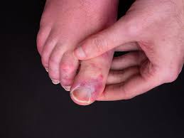 Image result for brown patches on the feet