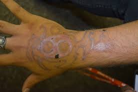 Minor scarring can be corrected via use of otc silicone scar. Laser Tattoo Removal Burns And Scars Pristine Laser Center Orlando