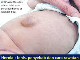 Terdapat beberapa sebab kenapa titik kelemahan boleh terhasil pada dinding abdomen. Hernia Jenis Penyebab Dan Cara Rawatan Wannura Terapi