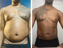 Image result for Liposuction