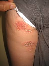 Bullous Impetigo Wikipedia Authoritative facts from dermnet new zealand. bullous impetigo wikipedia