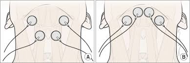 Changes In Hyolaryngeal Movement And Swallowing Function