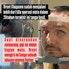 dr. Greg Moloney yang melakukan tindakan di RS Mount Saint Joseph, Kanada.  Tindakan teresebut lebih dikenal dengan “tooth-in-eye” (gigi dalam mata 😅)  Nama sebenarnya adalah osteo-odonto-keratoprosthedis. Menurut Beliau  tindakan ini hanya akan