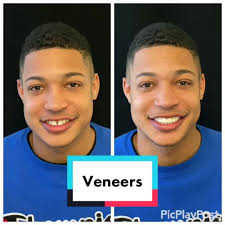 One of our #favorite smile makeovers #veneers #beforeandafter #change  #different #handsome #beauty #fashion #health #learning