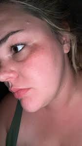 Hi I've managed to get some little white spots under one of my eyes I use  my cleansing balm, toner & MC day & night I also mix up moisturising with  the