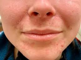 How to get rid of stretch marks. Pink Bumps Around The Mouth It May Not Be Acne Skincare Physicians