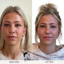 Zo Brightening Kit Before and After