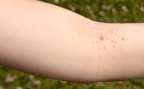 De fleste kløende utslett er ufarlige; Utslett Og Hudsykdommer