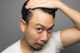 Pubic hair loss is hugely common, but it does happen, and if it happens to you, then the chances are that you are going to wonder why is my pubic hair falling out? At Age 18 John Figured Out He Was Balding From A Photo On Facebook Growing Up John Now A 28 Year Old San Francisco Going Bald Balding Hair Loss Treatments