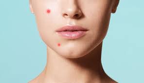 How To Treat A Painful Pimple - SELF | SELF