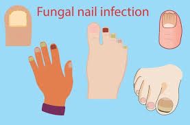 Image result for black toe diabetes