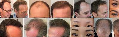 At la fue hair clinic we provide a natural looking and the best fue hair transplant and fue hair restoration services to clients who suffer from hair loss using the latest technique follicular unit extraction fue. Hair Transplant Los Angeles Eyebrow Restoration Marc Dauer Md