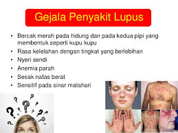 Simak pembahasan selanjutnya pada rubrik berikut ini! 0819 0502 6967 Xl Apa Itu Lupus Obat Lupus Obat Penyakit Lupus