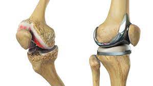 What Is Knee Replacement Surgery When Is It Necessary