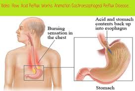Pin On Acid Reflux Videos