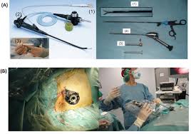 Image result for Intrapleural Anesthesia