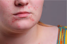 Image result for Erythromycin