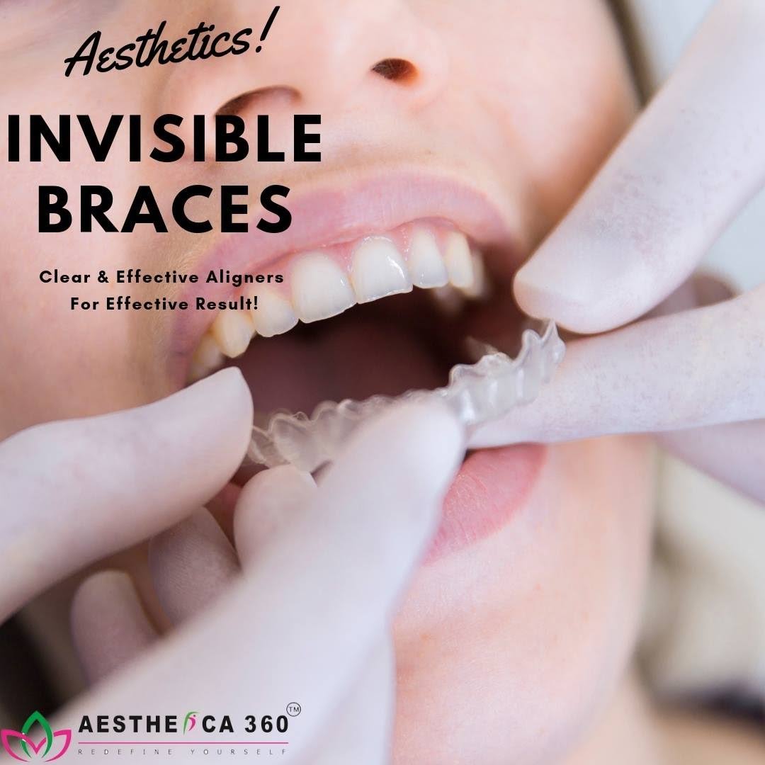Braces & Orthodontic consultation product image