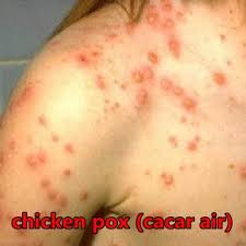 Penyakit chicken pox ini berlaku apabila terdapat jangkitan virus yang dikenali sebagai varicella. Apa Itu Penyakit Cacar Air Chicken Pox Ciktom