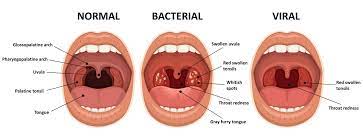 Tonsillectomy Tonsil Removal Surgery Gleneagles Hospital