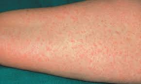 الحساسية وأنواعها المتعددة