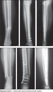 Isolated fibula fractures are rare in children. Treatment Of Distal Fractures Of The Tibia