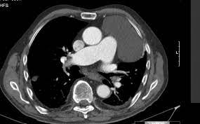 Check spelling or type a new query. Loculated Pleural Effusion Radiology Case Radiopaedia Org