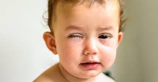 Infeksi Mata Pada Bayi Segera Atasi Dengan 5 Cara Rumahan Berikut Ini Theasianparent Indonesia