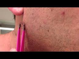When this happens, the affected area looks like a fully formed they say a picture is worth a thousand words. Ingrown Hair Removal Gross Videos Armpit Face Stomach