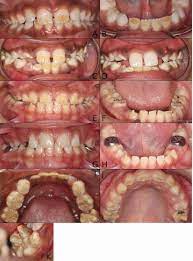 Oral Manifestations Of Vitamin D Deficiency In Children British Dental Journal