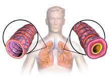 Reactive Airway Disease Wikipedia