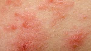 Insect Bite Allergies Crystal Lake Treat Insect Bite Crystal Lake Allergist Crystal Lake Il 60014