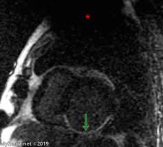 Maybe you would like to learn more about one of these? Cardiac Mri Scans In Patients With Pacemaker Defibrillators Myheart