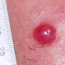 Image result for Merkel Cell Carcinoma