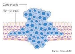 Get details on how breast cancer forms including changes or mutations in dna, genetic inheritance, lifestyle, or hormonal changes. How Cancers Grow Cancer Research Uk