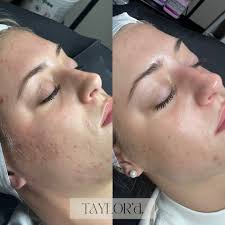 One month, one @skinpen Microneedling session + Even Tone Correcting Serum  by @skinbetter BYE ACNE SCARRING 👋🏼👊🏼 Not only were we able to  drastically reduce her scarring, but enhance her complexion and