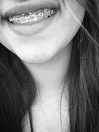 Smiley Piercing With Braces Smiley Piercing Piercing Piercings